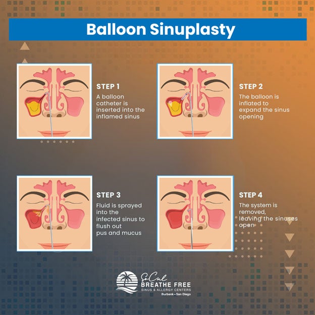 Balloon Sinuplasty