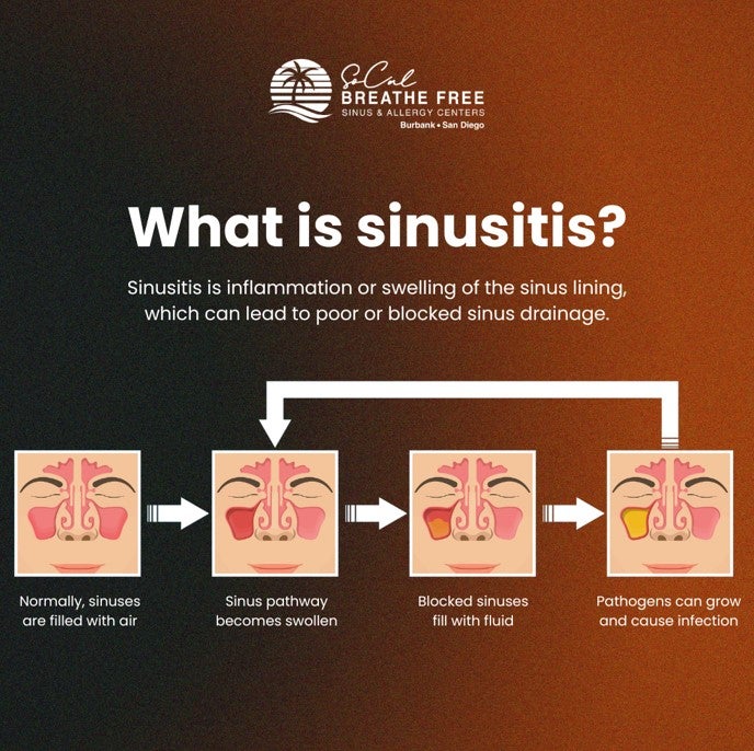 Treatment for Sinusitis in Burbank & San Diego, CA
