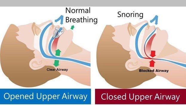 Sleep Apnea and Snoring Treatment Options in San Diego, CA