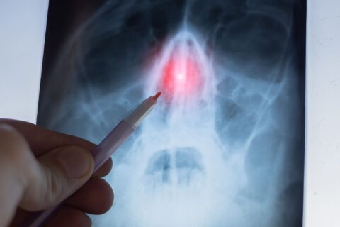 A person holds a pen near an X-ray showing a deviated septum, taken in Burbank, CA.