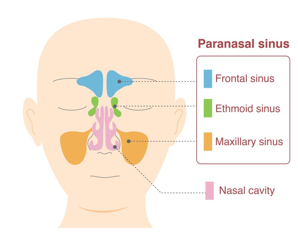 Illustration showing nasal sinuses and polyps, linked to spring allergies in Burbank, CA.