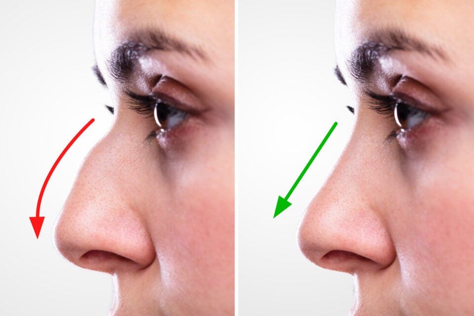 Before and after nose alignment in rhinoplasty procedure in Burbank, CA